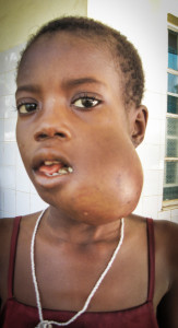 Hassanatu Bangura before chemo treatment - 2012.