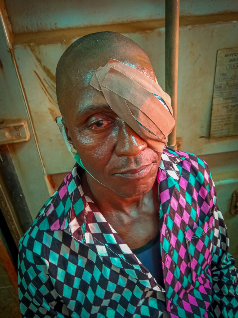 On February 10, Bai Sesay, who had been blinded by cataracts, visited our base in Freetown shortly after cataract surgery to his left eye. His right eye was still recovering from cataract surgery done over one week before.